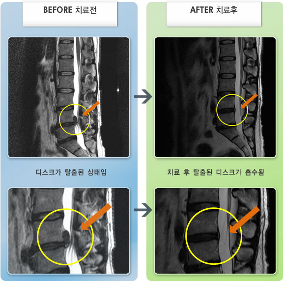 노원자생한방병원 치료사례 MRI로 보는 치료결과-우측 허리와 다리 통증 및 저림