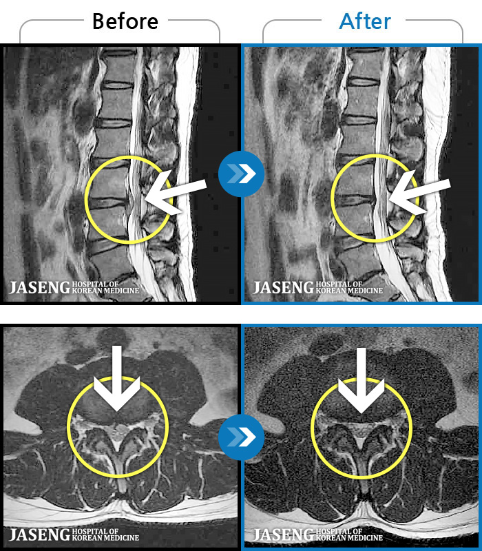 �ڻ��ѹ溴�� ġ���� MRI�� ���� ġ����-��ġ���� ���� �ٸ����� ����, �������� ������ ���� �����. 