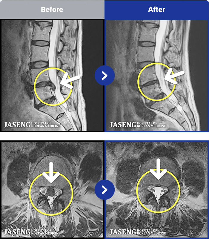 �ڻ��ѹ溴�� ġ���� MRI�� ���� ġ����-�㸮�� ���� �ٸ��� ���� ����