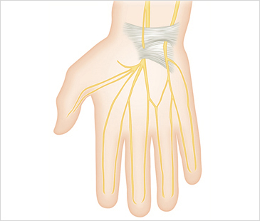 노원자생한방병원 기타관절질환 손목터널증후군-손목터널증후군에 관련된 이미지 입니다.