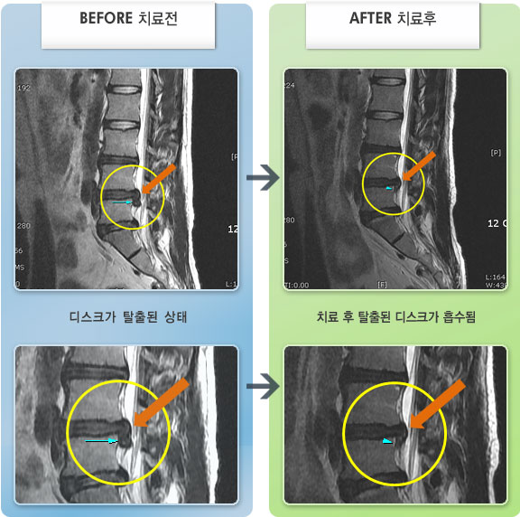 자생한방병원 치료사례 MRI로 보는 치료결과-제대로 서있을 수 없을 만큼의 좌하지 방사통과 수면시 통증으로 수면이 어려운 상태